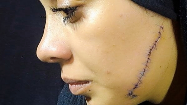 Novia egipcia sufre un ataque horrible: 41 puntos en su cara días antes de su boda