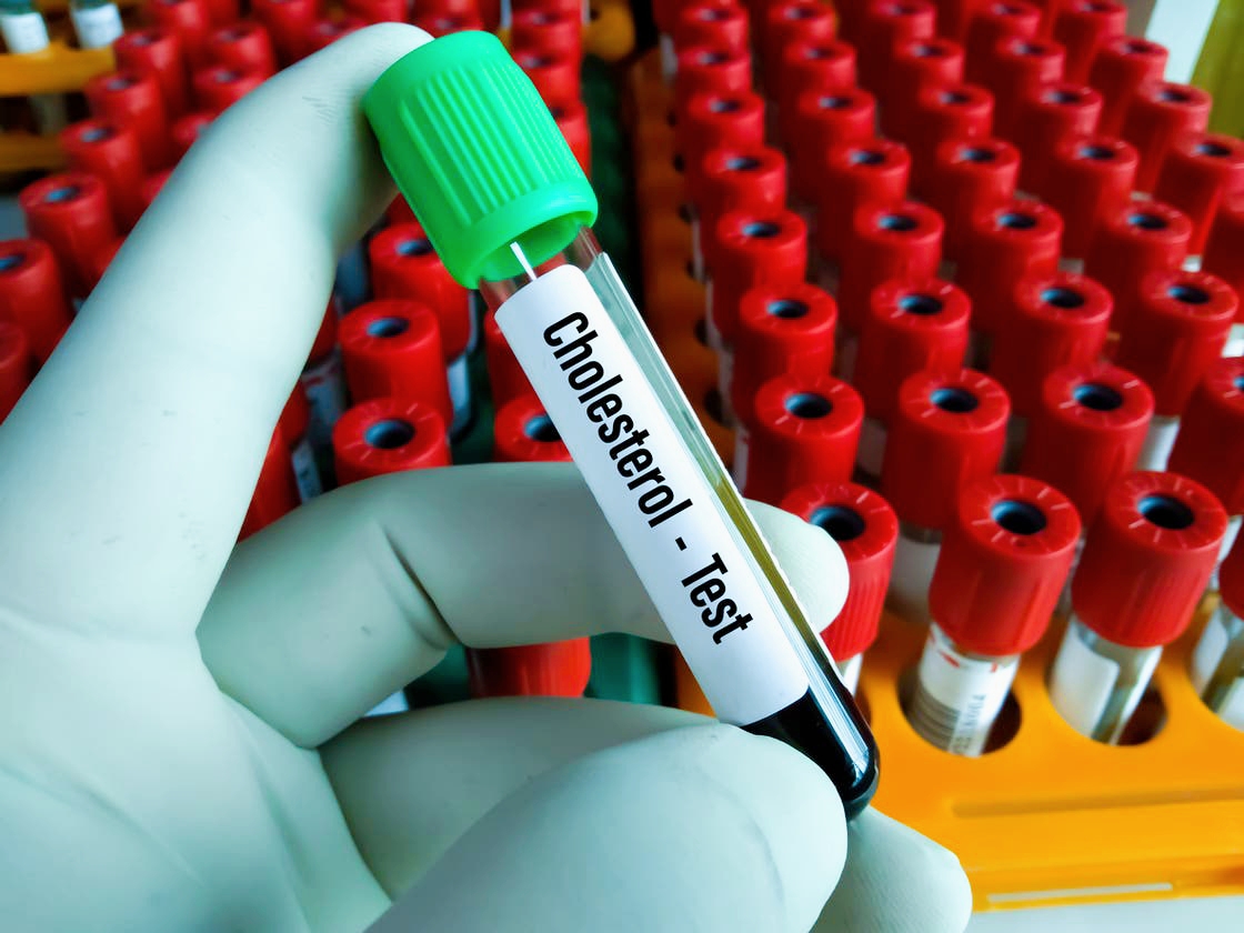 New Oral Medication Significantly Lowers Bad Cholesterol Levels