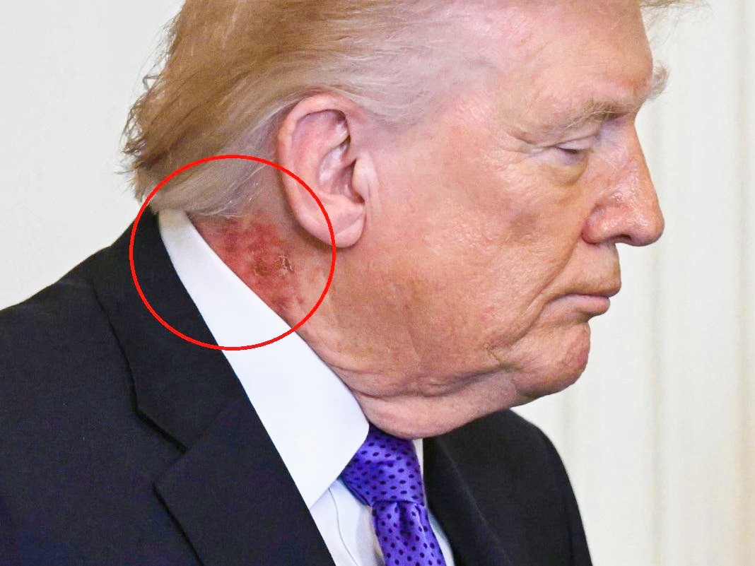 Trump's roter Hautausschlag wirft Fragen auf, und sein Arzt erklärt den Grund