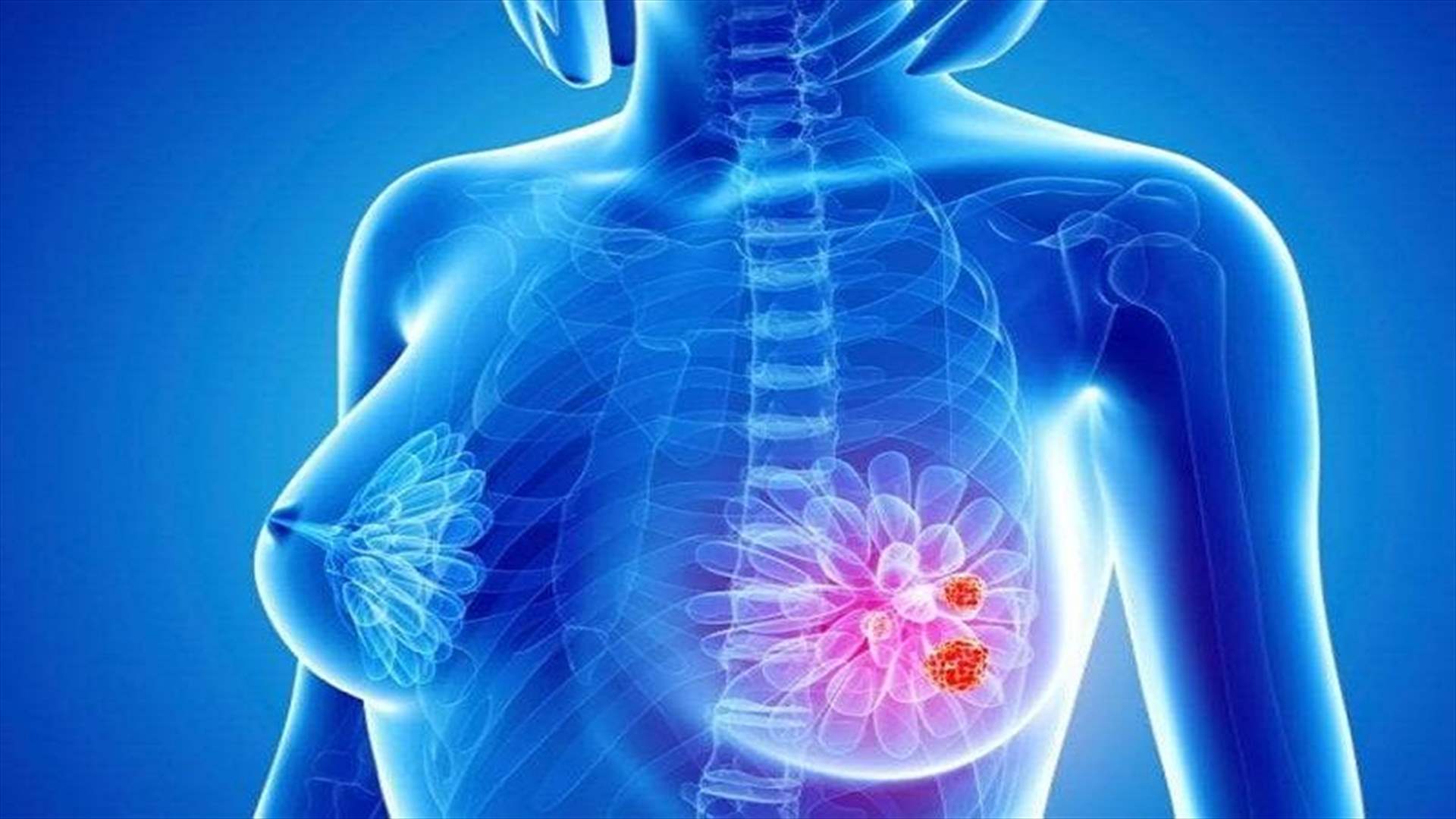 Neue Studie zeigt: Stress kann das Risiko für erblichen Brustkrebs bei Trägern von BRCA-Mutationen erhöhen