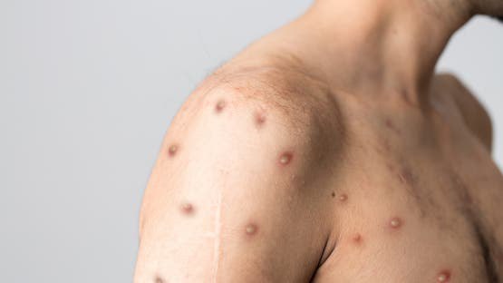 Die Weltgesundheitsorganisation hebt den globalen Notstand für Affenpocken nach Rückgang der Infektionen auf