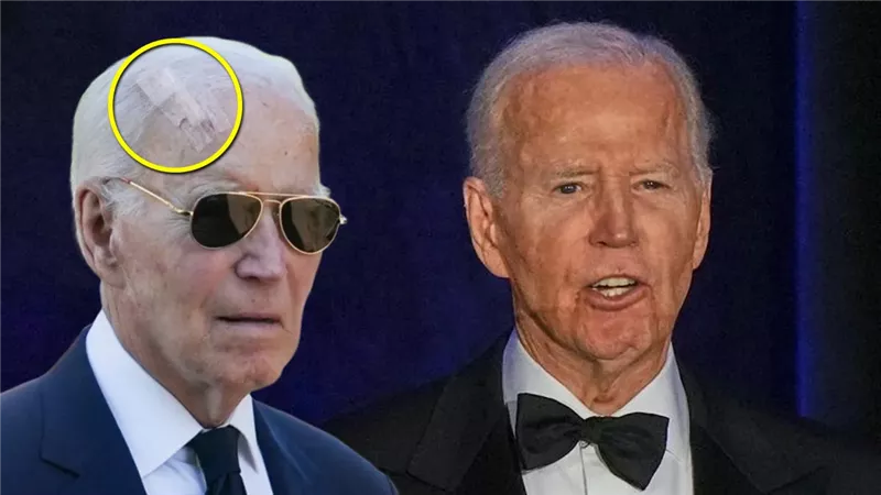 Biden unterzieht sich einer neuen Operation zur Entfernung von Hautkrebszellen